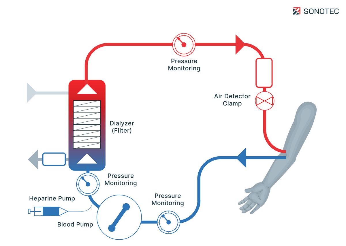 Illustration Hemodialysis With Bubble and Blood Leak Detector - © SONOTEC GmbH 